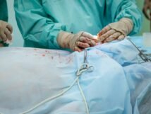 Photo weight loss surgery